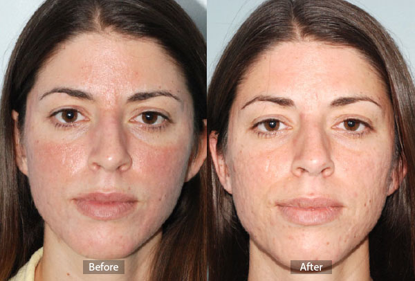 Fraxel Laser Before And After Acne Scars