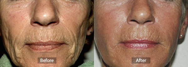 Collagen Before and After