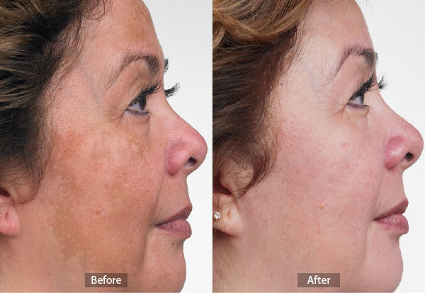 Hyperpigmentation Before and After