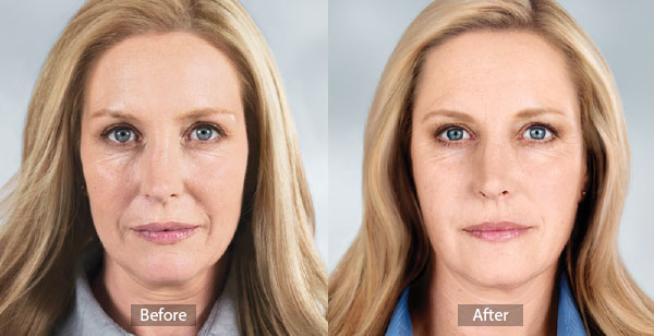 Sculptra Aesthetic Before and After