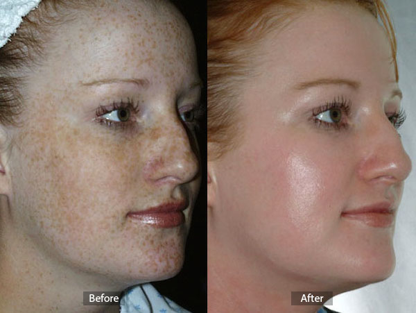 Chemical Peel Before and After