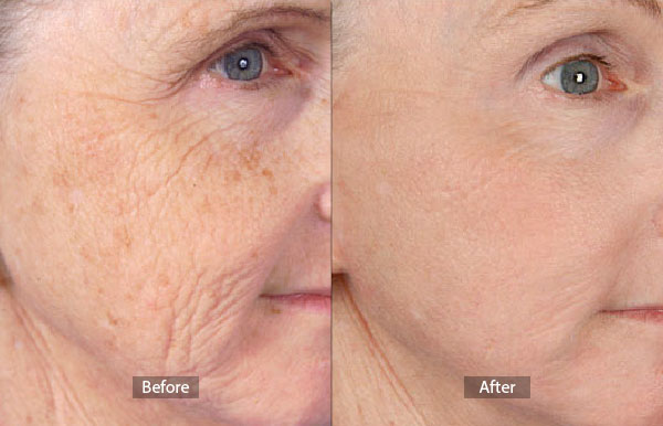 Laser Surgery Before and After