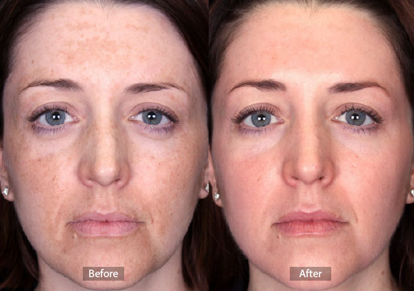 Mask of Pregnancy Before and After